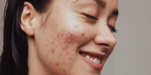 Scientists Found a Novel Way to Defeat Acne from Within